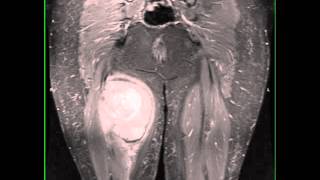 Synovial Sarcoma, Thigh