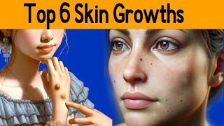 Top 6 six skin growths: From Moles to Warts - A Complete Guide