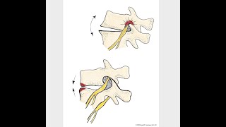 Contraindications to low back arching in discogenic or multi-componental low back pain