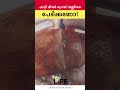 ഫാറ്റി ലിവർ ഗ്രേഡ് വണ്ണിനെപേടിക്കണോ what does mild fatty liver and how is it treated