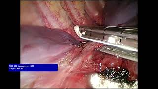 ผ่าตัดส่องกล้องตัดกลีบปอดในเด็ก ( VATS in pulmonary sequestration)