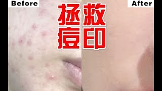 我的痘印消失了？10年痘龄6分钟去痘印分享！最有效的医美去红痘印方式！无废话！就是超强干货！