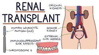 Understanding Kidney Transplants