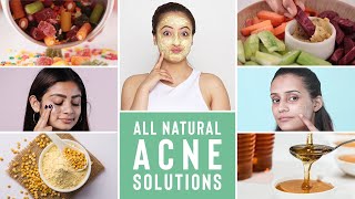 Causes & Ways To Treat Acne In Humid Weather Conditions | Home Remedies | Humid Weather Series Ep 4