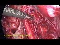 laparoscopic pelvic ureterolysis