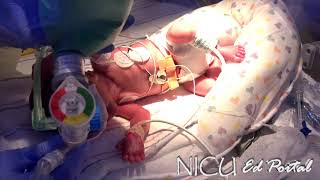 Surfactant administration (NICU)