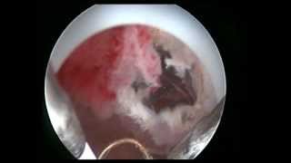 Art of hysteroscopy by osama shawki,perforation!