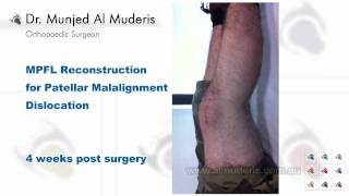MPFL Reconstruction for Patellar Malalignment Dislocation - 4 weeks post surgery