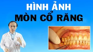 Hình ảnh mòn cổ răng I Phạm Thành Công