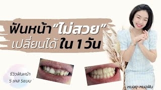 ฟันหน้า”ไม่สวย”แก้ไขได้ใน 1 วัน