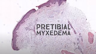 Pretibial myxedema (Graves disease thyroid dermopathy) pathology dermpath dermatology USMLE