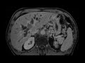 מקרה השבוע perihilar cholangiocarcinoma klatskin tumor ct ו mri