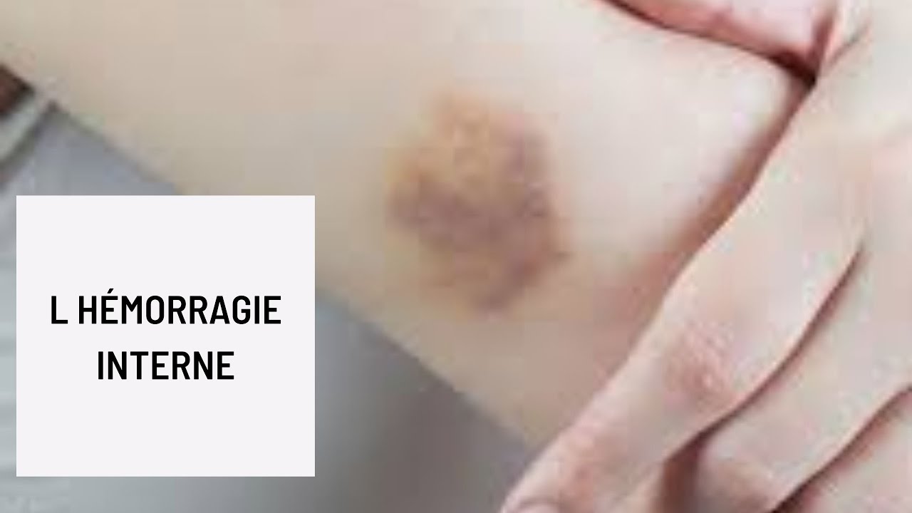 L Hémorragie Interne Youtube