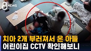 치아 2개 부러져서 온 아들…어린이집 CCTV 확인해보니 / SBS 8뉴스