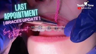 Braces Check ups |UPDATE| Permanent lower retainer - Last Appointment  Tooth Time Family Dentistry