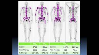 Operationalization of Radium-223 Therapy for Bone Metastases - Eric Rohren