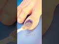 How Toenail Removal Works. #toenails #doctor #neet #facts #animation #science #cartoon #anime