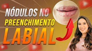 NÓDULOS NO PREENCHIMENTO LABIAL | DRA VANESSA DEFELÍCIBUS