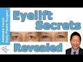 Must see Eyelift Secrets Revealed. Learn the Basics on Browlift, Upper & Lower Eye Lift, Seattle