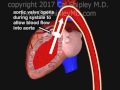 coronary artery perfusion and the cardiac cycle animation by dr. cal shipley m.d.