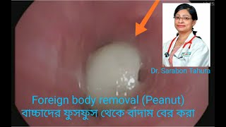 Bronchoscopic Foreign Body Removal Peanut Foreign Body Removal at SQUARE HOSPITALS LTD #BD_ENDOSCOPY