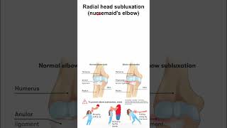 Radial head subluxation (nursemaid's elbow)