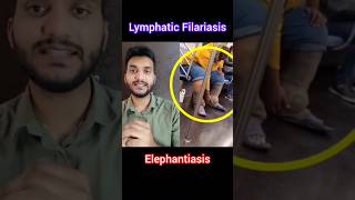 Lymphatic Filariasis #elephantasis