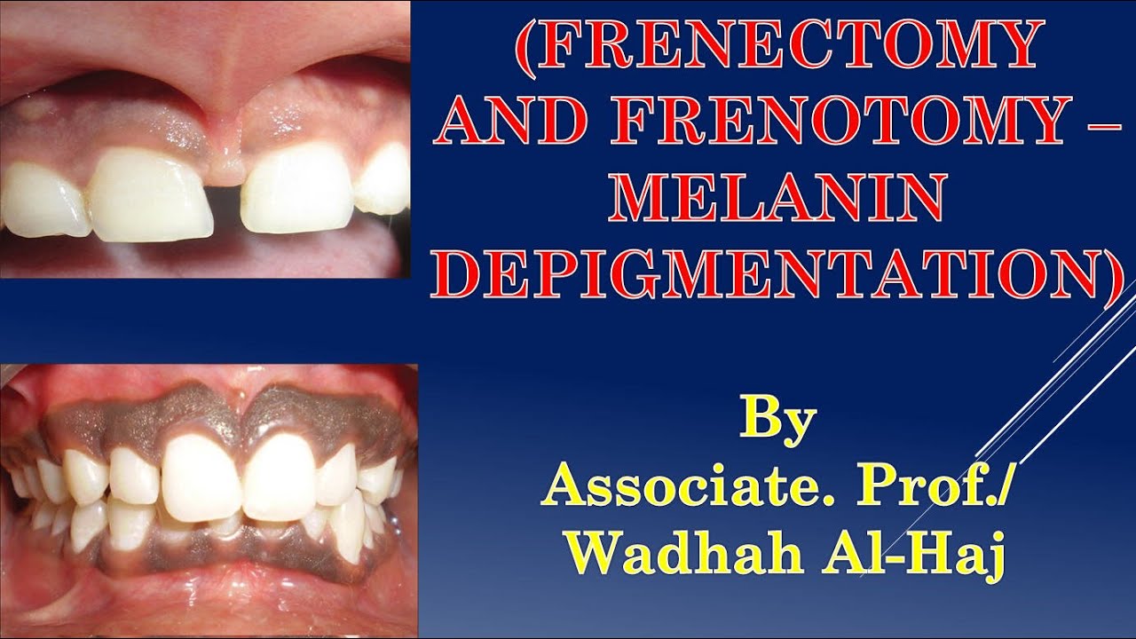 41-Periodontal Surgery-10(Frenectomy And Depigmentation)-Wadhah ...