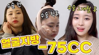 얼굴에 있는 지방 다 빼고왔어요 :) | 이중턱 + 심부볼 지방흡입 | 디마레TV