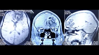 LARGE FRONTAL LOBE DERMOID-MICROSURGICAL REMOVAL-dr suresh dugani/HUBBALLI/KARNATAKA/INDIA