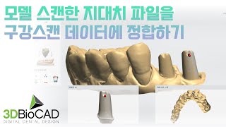 3Shape 모델 스캔한 지대치 파일을 어버트먼트가 체결된 상태의 스캔파일에 정합하는 방법