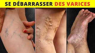 10 Façons Naturelles pour se Débarrasser des Varices et Augmenter le Flux Sanguin !