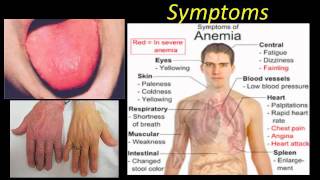 Pernicious Anemia