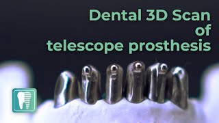 Scanning telescopic denture with SCANTIST 3D vanishing