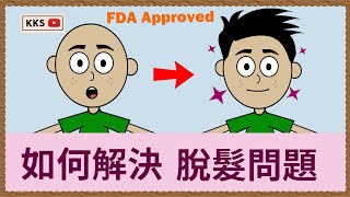 【健康生活系列】脫髮治療👨‍🦲，美國FDA認可防脫髮兩大方法，脫髮救星👍🏻，m字額救星👍🏻