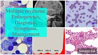 Multiple myeloma: Pathogenesis, Symptoms, Diagnosis, Treatment  #myeloma #medicine #hematology