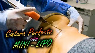 MINI LIPO MELA en CINTURA  🔥 \