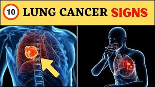 Lung Cancer Warning Signs - 10 Lung Cancer Symptoms