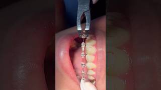 This Is Why Getting Braces Removed Is PAINLESS! 😃🦷