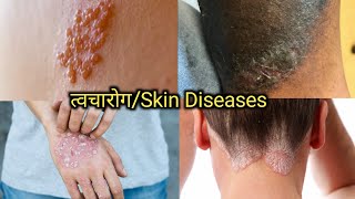 त्वचारोग व उपाय | त्वचा रोगाचे प्रकार | twacha Rog marathi | types of skin disease | twacha Rog type