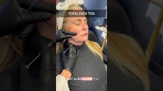 Total Face Tox Trending In 2025 #botox #cosmeticinjectables #beauty #antiaging