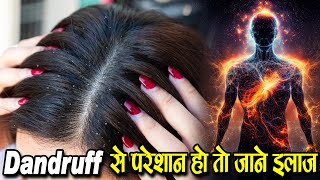 Dandruff से परेशान हो तो जाने इलाज - Get Rid of Dandruff Permanently #healthiswealth #motivation