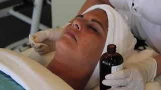 How to Use TCA Skin Peel