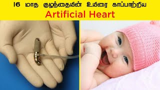 16 மாத குழந்தையின் உயிரை காப்பாற்றிய Artificial Heart | Tamil | #shorts