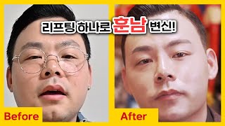 리프팅 하나로 훈남 변신?! (feat.레이저리프팅, 실리프팅, 스킨부스터)