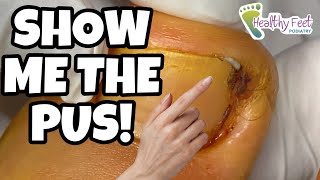 SURPRISE PUS POCKET HIDING UNDER AN INGROWN NAIL AND THE SECRET TO A PAINLESS NAIL REMOVAL!