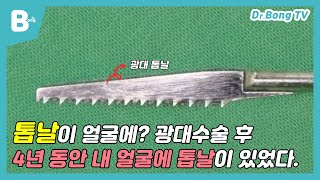 [닥터봉TV_CBK성형외과_최봉균] 톱날이 얼굴에? 광대 수술 후 4년 동안 내 얼굴에 톱날이 있었다.[CBK整形外科_チェ·ボンギュン] 頬骨手術後4年間、私の顔に鋸刃があった