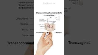 Understand the Risk of Chorionic Villus Sampling (CVS) #Pregnancy #PrenatalTesting #CVS