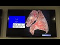 introduction to lung pathology