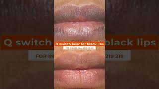 You Will Never Believe These Bizarre Truths Behind Q Switch Laser For Black Lips.  #blacklips